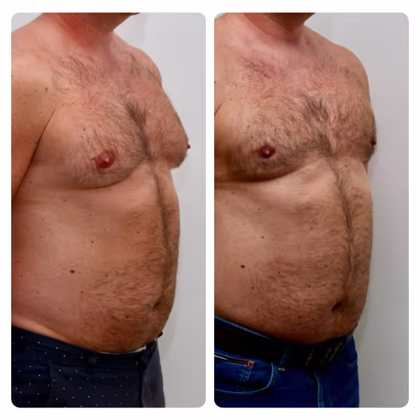 Gynecomastia Surgery in Turkey